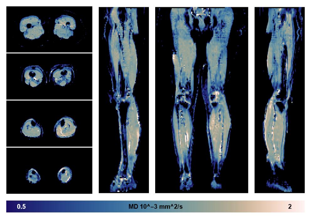 IVIM corrected whole leg muscle mean diffusivity obtained from diffusion tensor imaging.